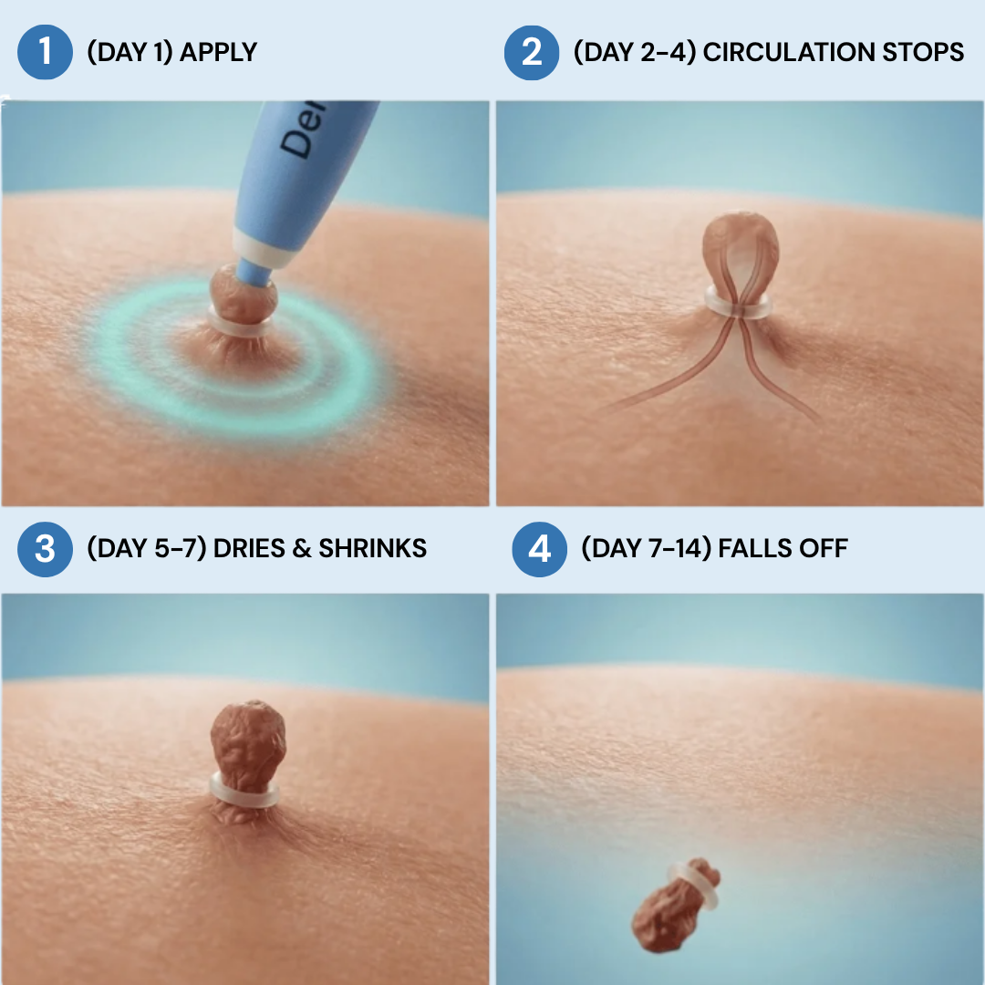 PuraSkin™ Skin Tag Remover Kit