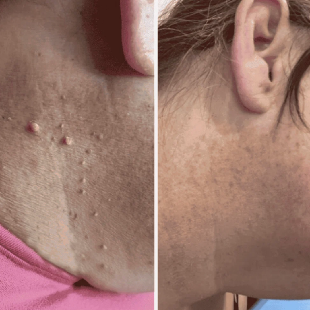 PuraSkin™ Skin Tag Remover Kit